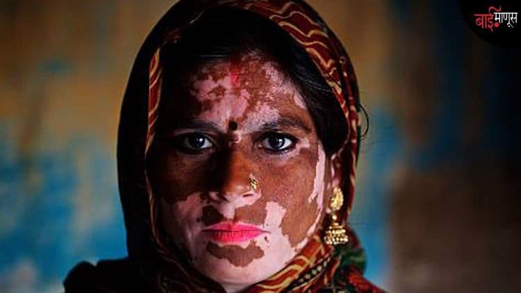 ‘’पांढऱ्या डागांमुळे नाही, लोकांच्या वागण्यामुळे आम्ही तुटलो’’... ‘विटिलिगो’सोबत जगणाऱ्या महिलांच्या संघर्षाच्या कहाण्या!