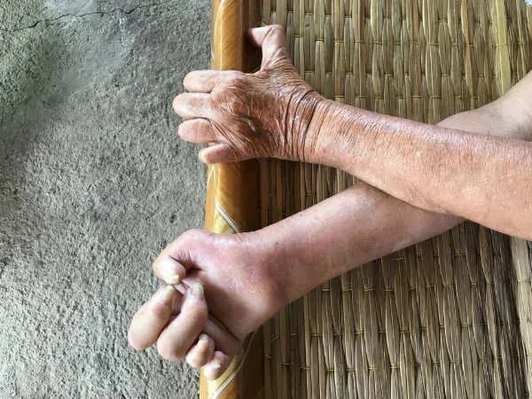 आपण कुष्ठरोग निर्मूलनाच्या अद्याप जवळपासही पोहोचलेलो नाही…